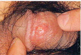 梅毒の初期感染